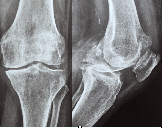 Τι είναι η αρθρίτιδα του γόνατος;